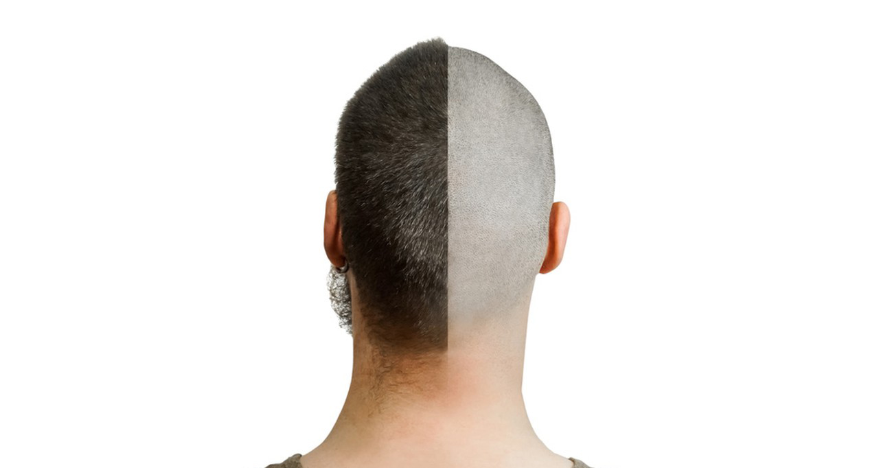 Difference between Minoxidil and Minoxidil Tincture-Xi'an Lyphar Biotech Co., Ltd Difference between Minoxidil and Minoxidil Tincture-Xi'an Lyphar Biotech Co., Ltd